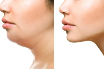 Double Chin or Skin Laxity?