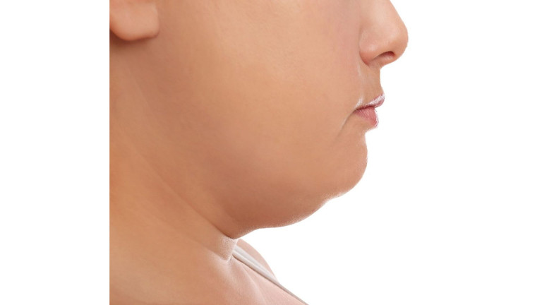 Double Chin
