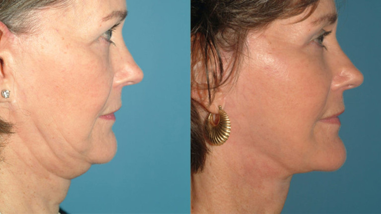 Surgical Neck Lift
