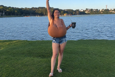 gigantomastia